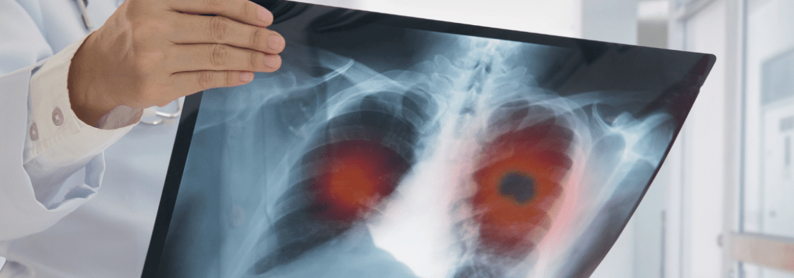 Akciğer Kanseri Nedir ? Nedenleri ve Tedavisi
