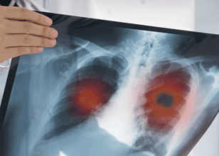 Akciğer Kanseri Nedir ? Nedenleri ve Tedavisi