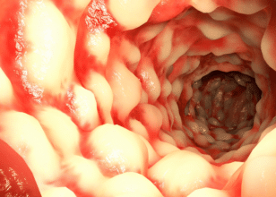 Crohn Hastalığı Belirtileri ve Tedavi Yöntemleri