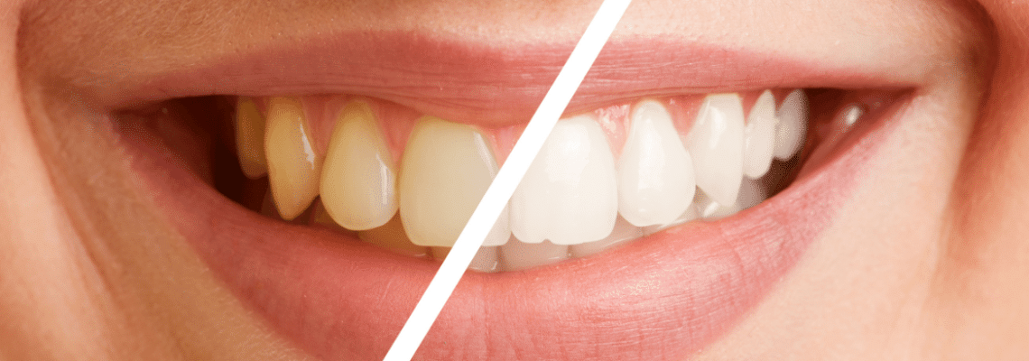 Diş Temizletme İşleminin Faydaları