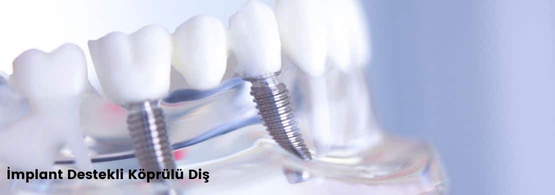 implant destekli köprülü diş